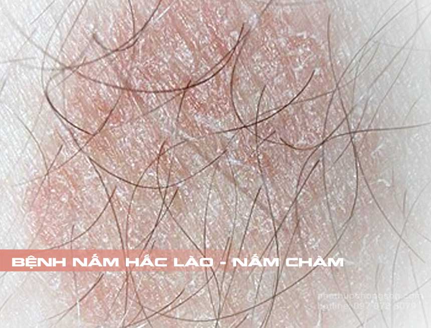Bệnh Hắc Lào- Cách Chữa Trị Tận Gốc Cần Lưu Ý Gì?