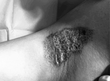 Hoại Tử Nách Sau Chiếu Plasma Trị Tăng Tiết Mồ Hôi